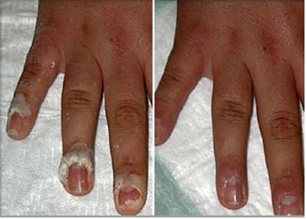 از بین بردن زگیل های متعدد در انگشتان دست (قبل و یک ماه پس از درمان با لیزر) پاسخ درمانی خوب است