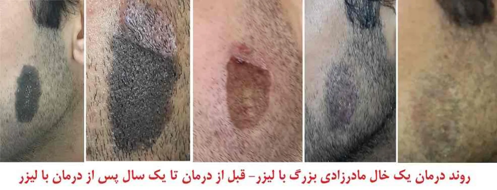 روند درمان برداشتن خال صورت : یک خال مادرزداری 1.5 * 6 سانتیمتر در صورت یک جوان 27 ساله - قبل از درمان - 2 هفته پس از تست لیزر، بلافاصله پس از درمان، 3 ماه پس از درمان و یک سال پس از درمان با لیزر (نتایج رضایت بخش است)