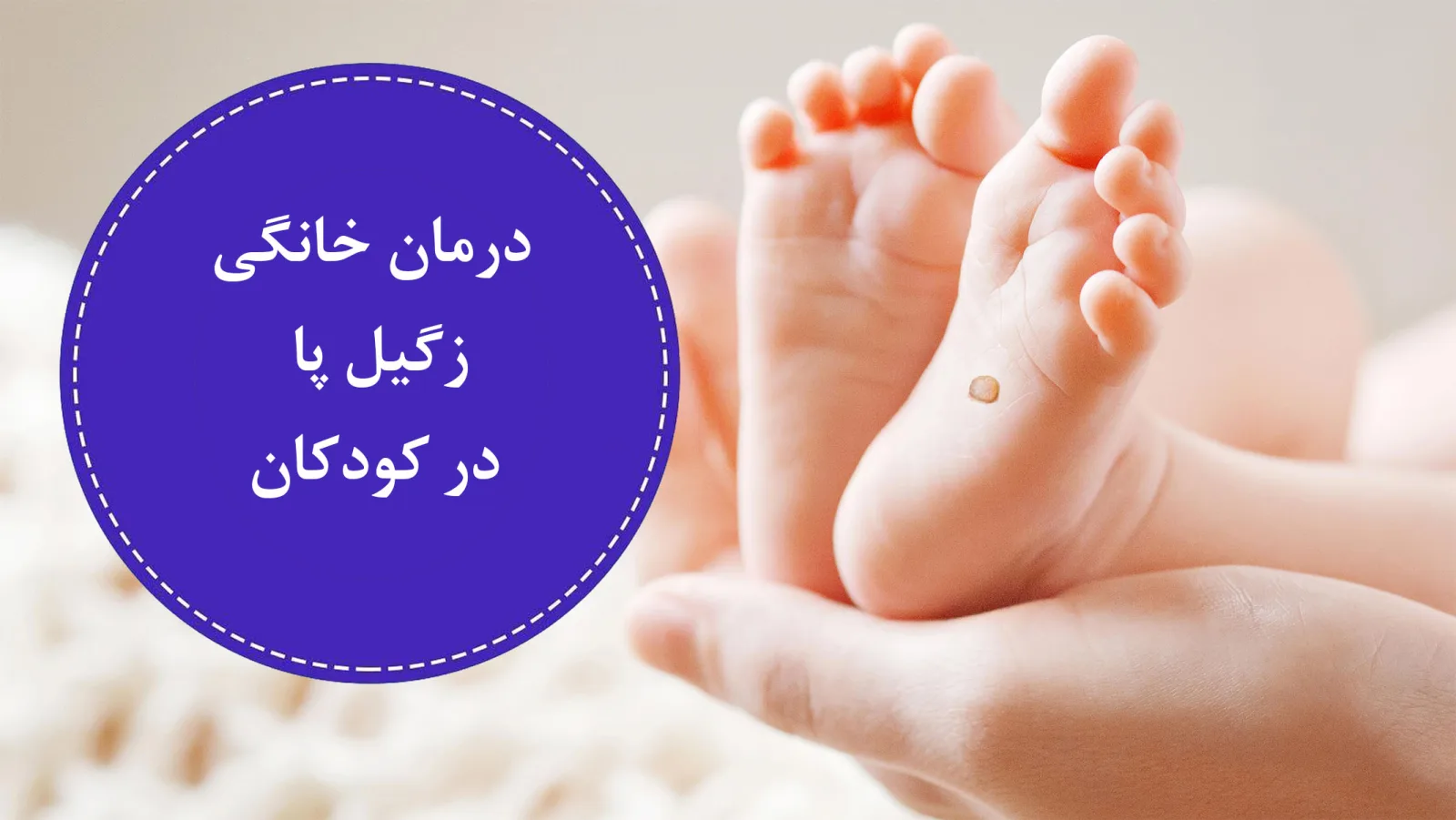 درمان خانگی زگیل پا در کودکان