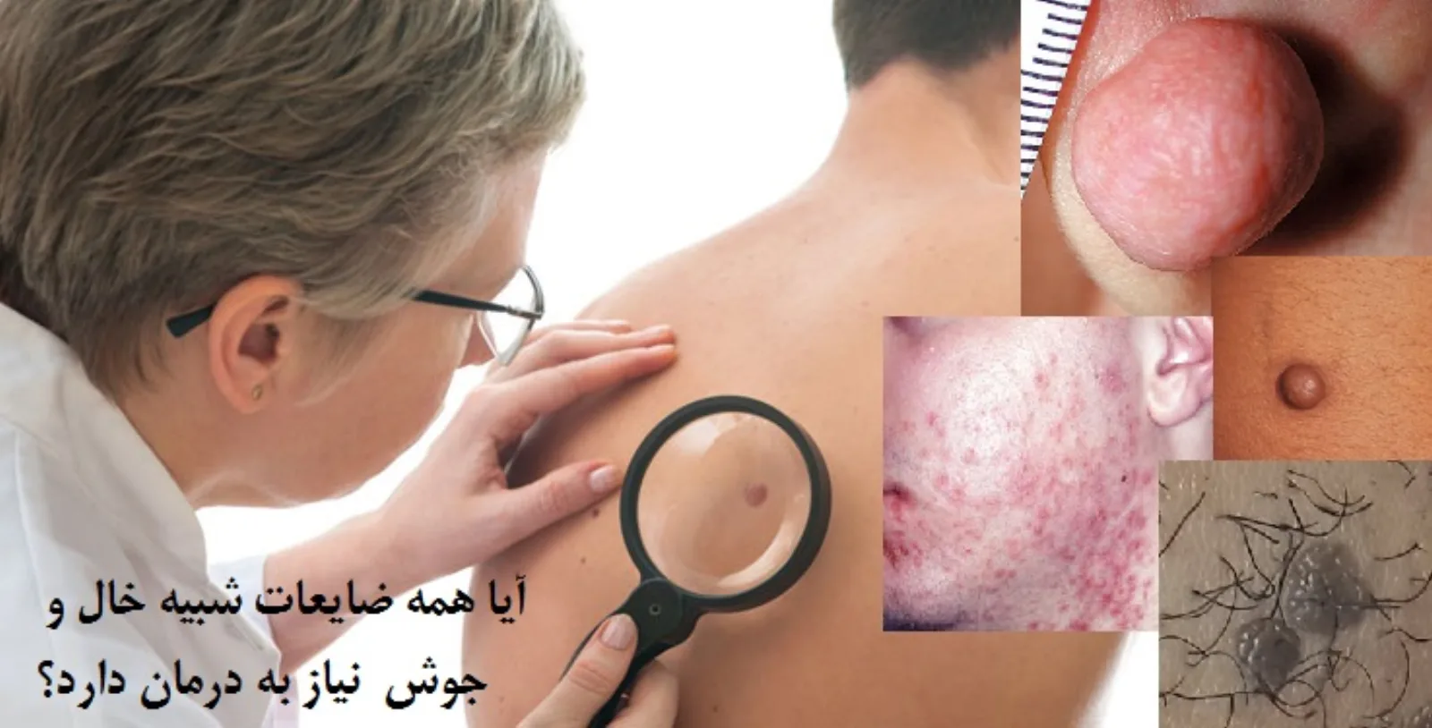 فرق گوشت اضافه و زگیل چیست؟