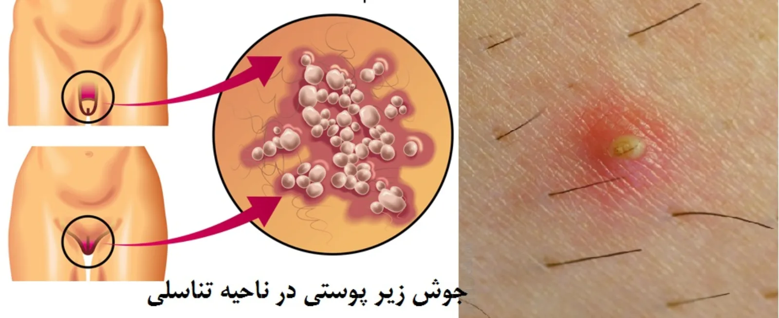 جوش تناسلی (تشخیص و درمان)