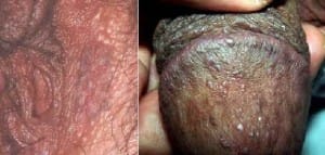 برجستگی های بسیار کوچک صورتی براق روی آلت تناسلی - لیکن پلان