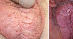 خارش مزمن پوست کیسه بیضه یا لب بزرگ و آلت تناسلی - لیکن سیمپلکس مزمن