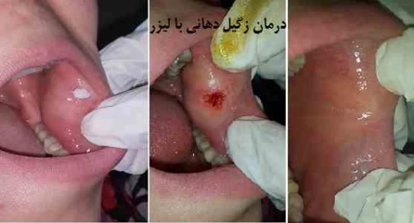 درمان زگیل دهانی با لیزر