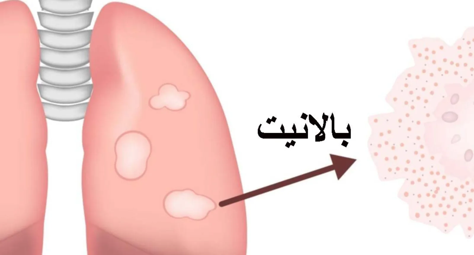 بالانیت