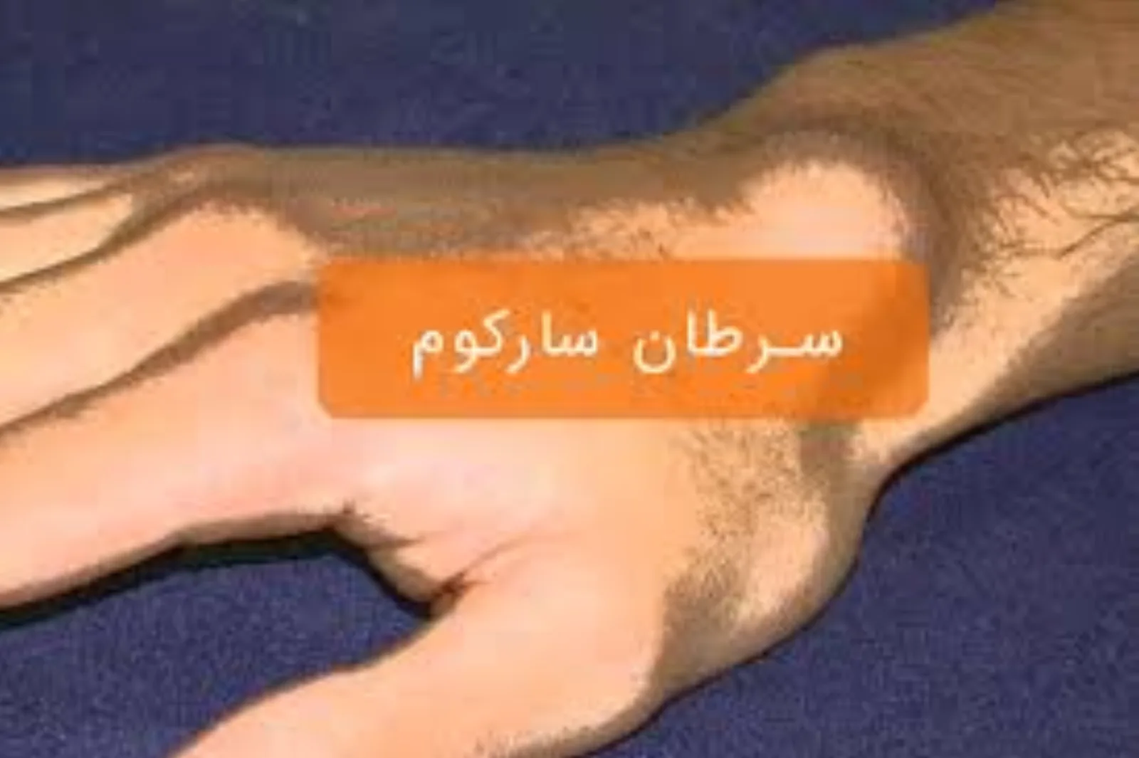سرطان سارکوم بافت نرم