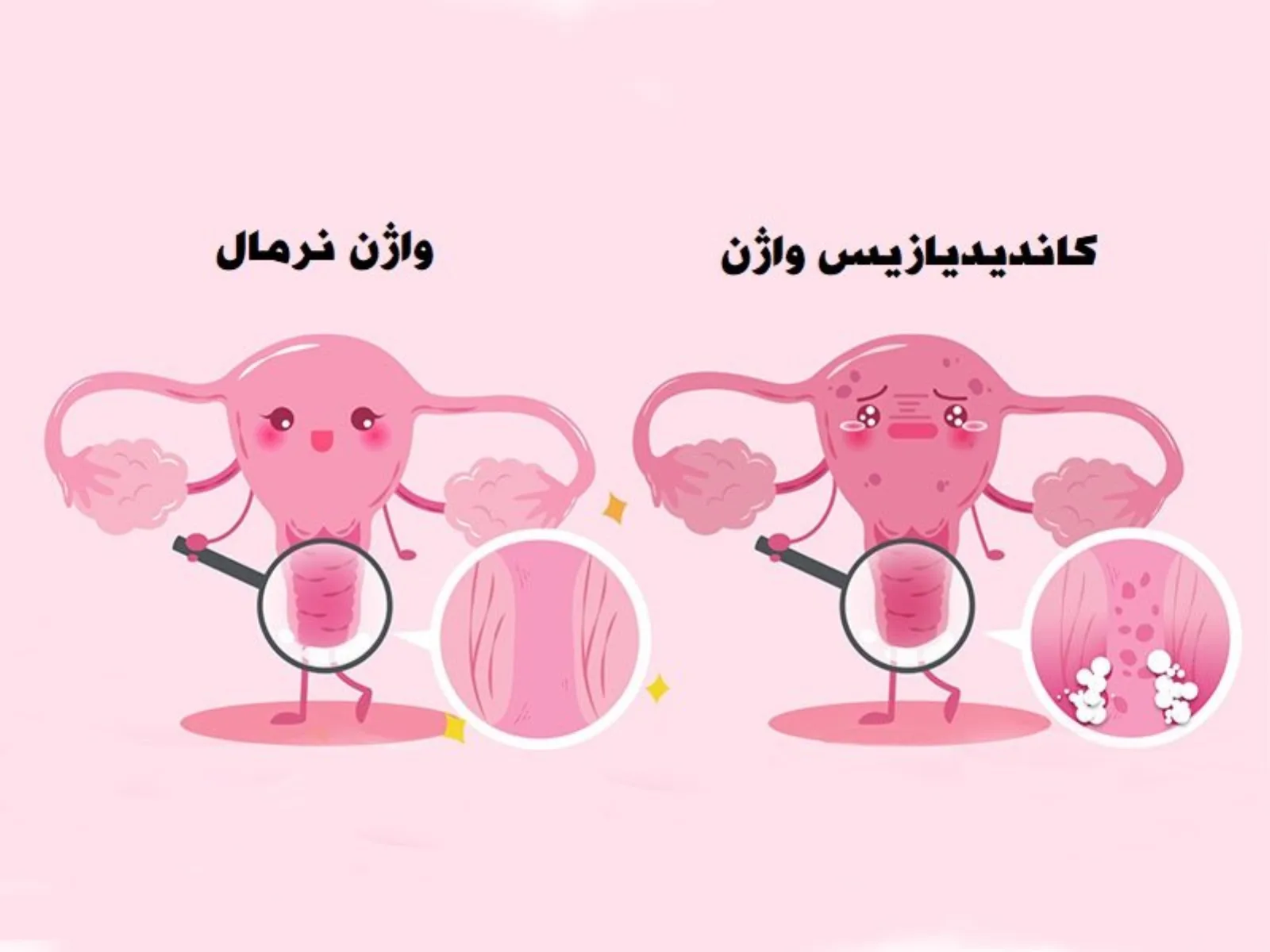 درمان خانگی عفونت واژن زنان - درمان عفونت قارچی واژن با سرکه سیب و ماست