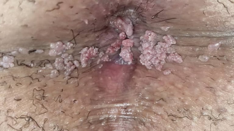زگیلهای گل کلمی شکل در مردان ناشی از ویروس HPV