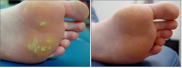 از بین بردن زگیل کف پا (قبل و یک ماه پس از درمان) پاسخ درمانی عالی است