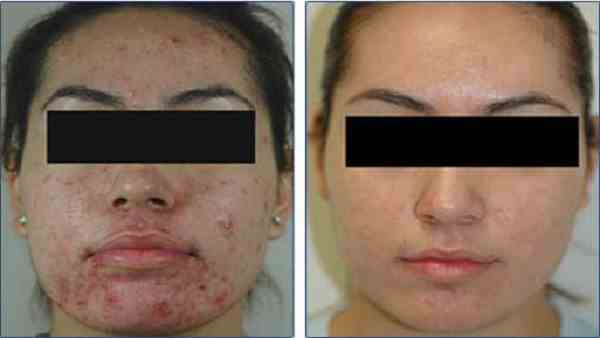 درمان جوش صورت در زنان