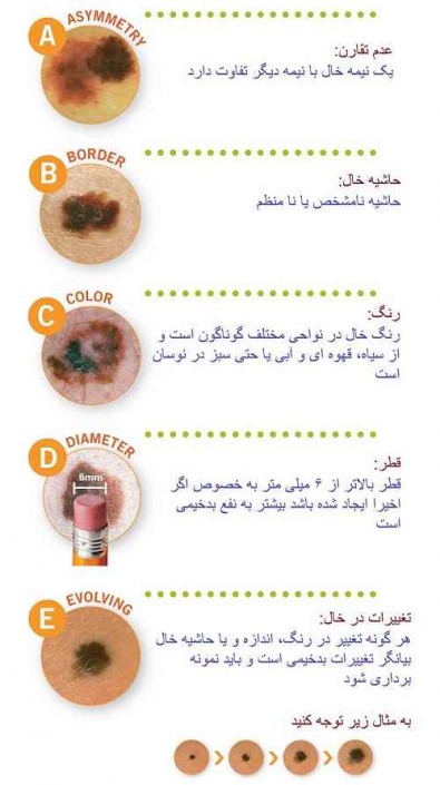 تشخیص خال‌های پوستی : راهنمای جامع برای مبتدیان