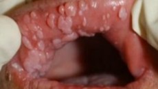 زگیل تناسلی چیست - علائم دهانی