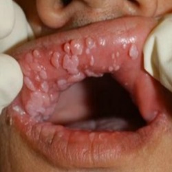 ضایعات متعدد دهانی با منشا زگیل تناسلی (خطر سرطان دهان و حلق افزایش می یابد)