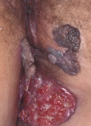 آلودگی HPV به شکل زگیل روی مقعد همراه با سرطان scc ناشی از آن