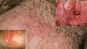 Herpes-G-300x171.jpg