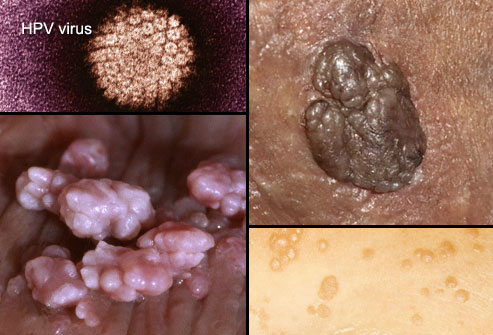 HPV عامل زگیل تناسلی