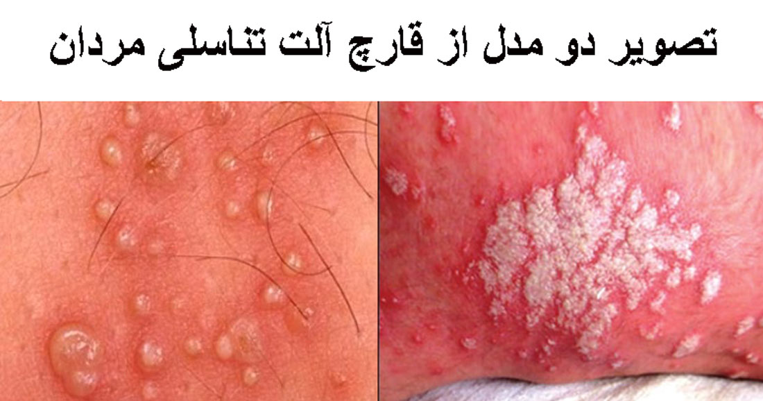 عکس زخم دستگاه تناسلی مردان